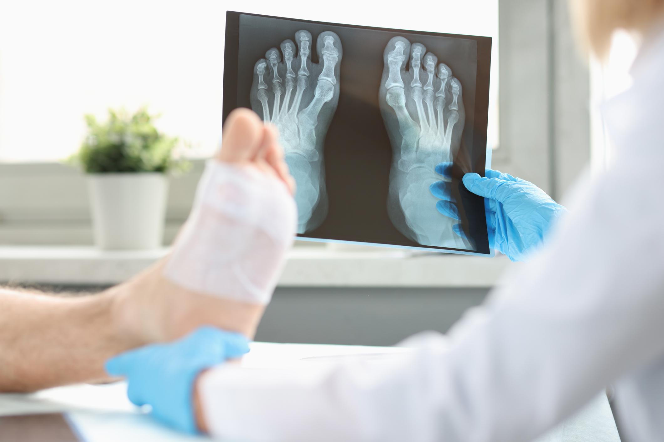 The Truth About Foot Fractures