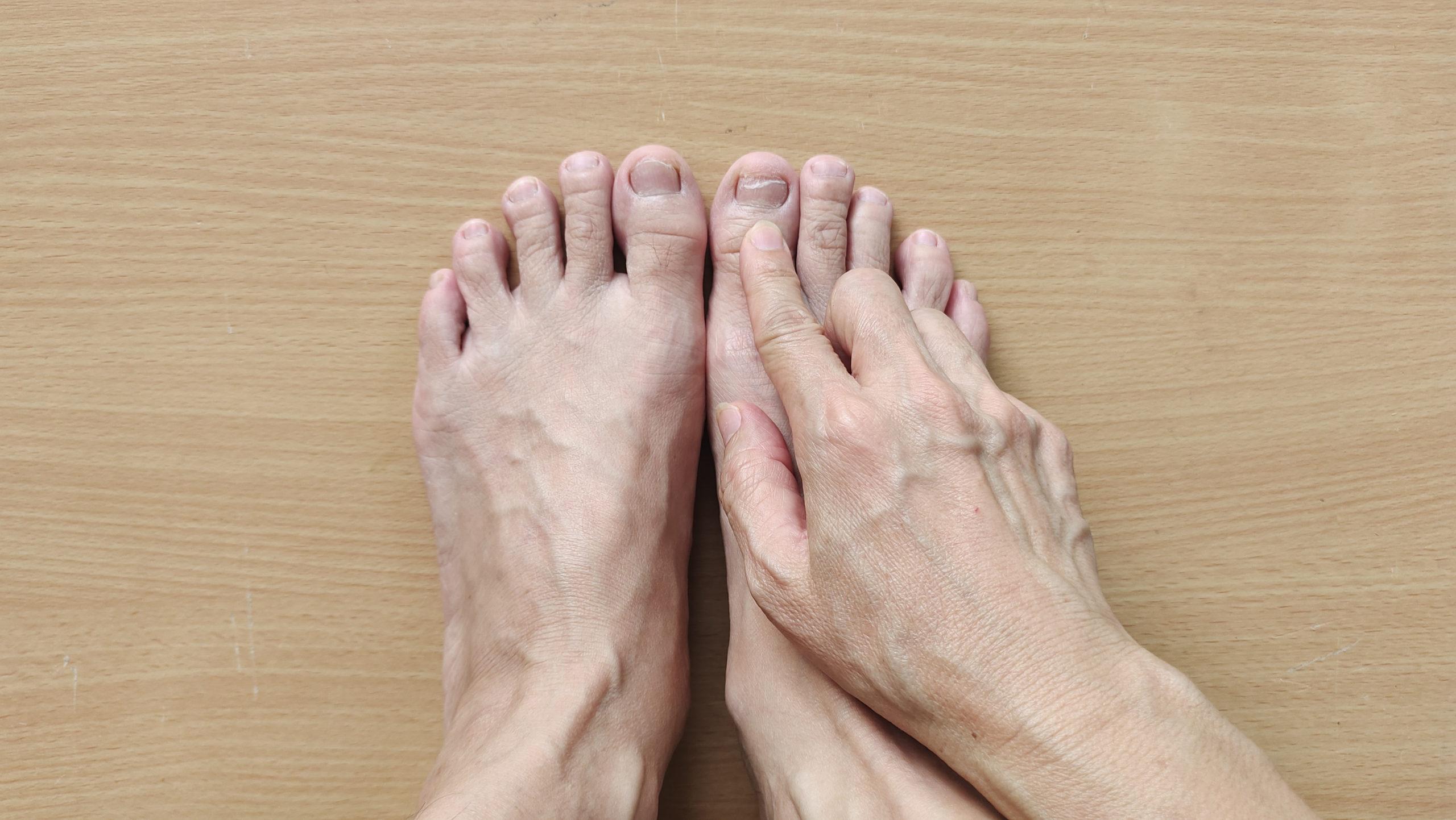 Arthritis: Types, Symptoms, and Treatment