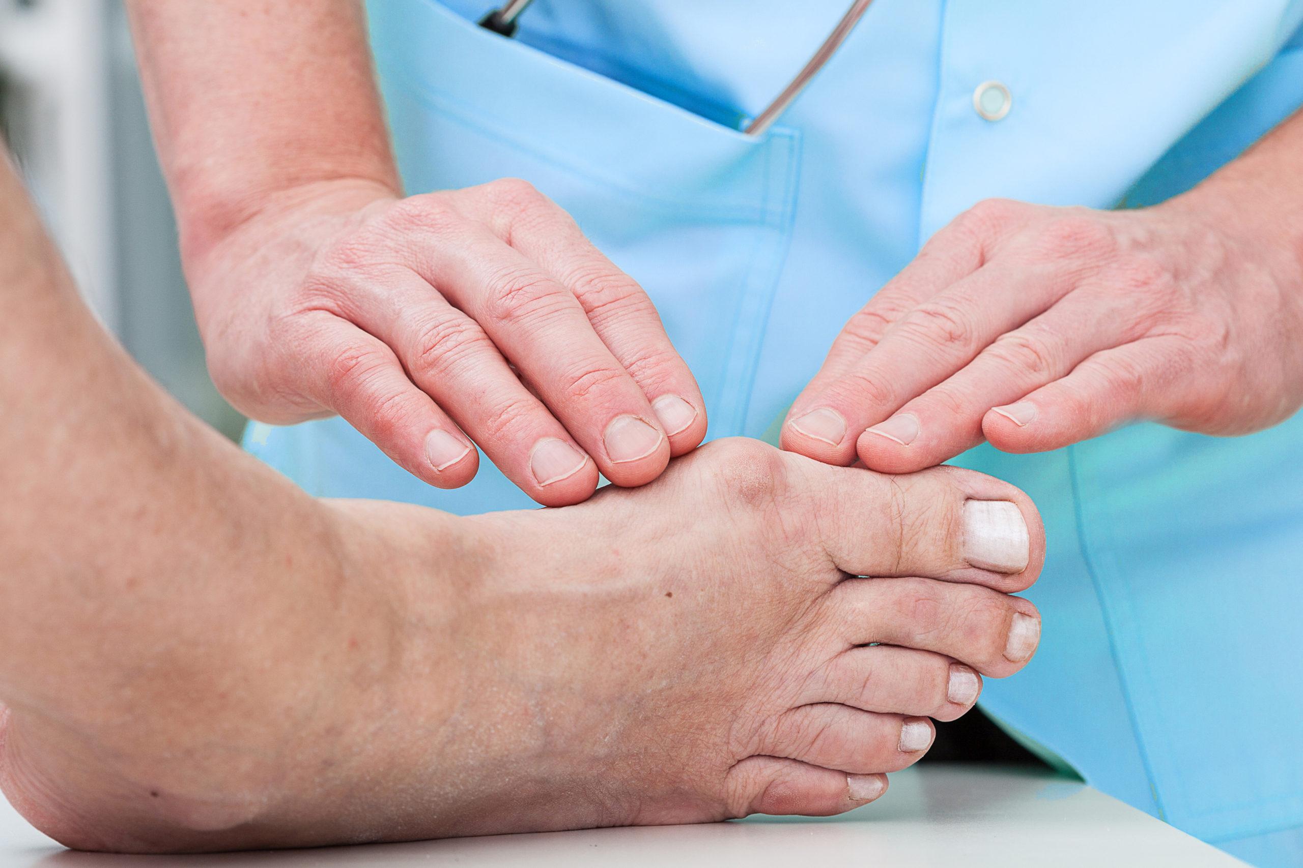 Gout: Definition, Causes, and Treatment