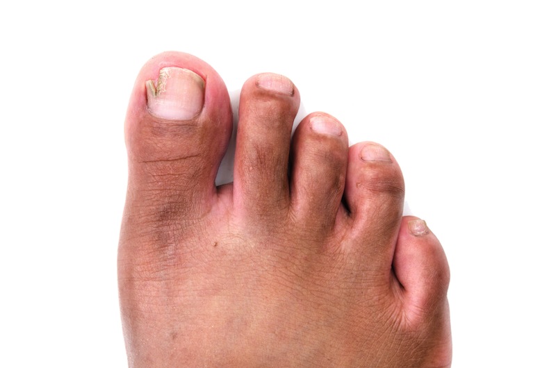 The Painful Truth About Ingrown Toenails