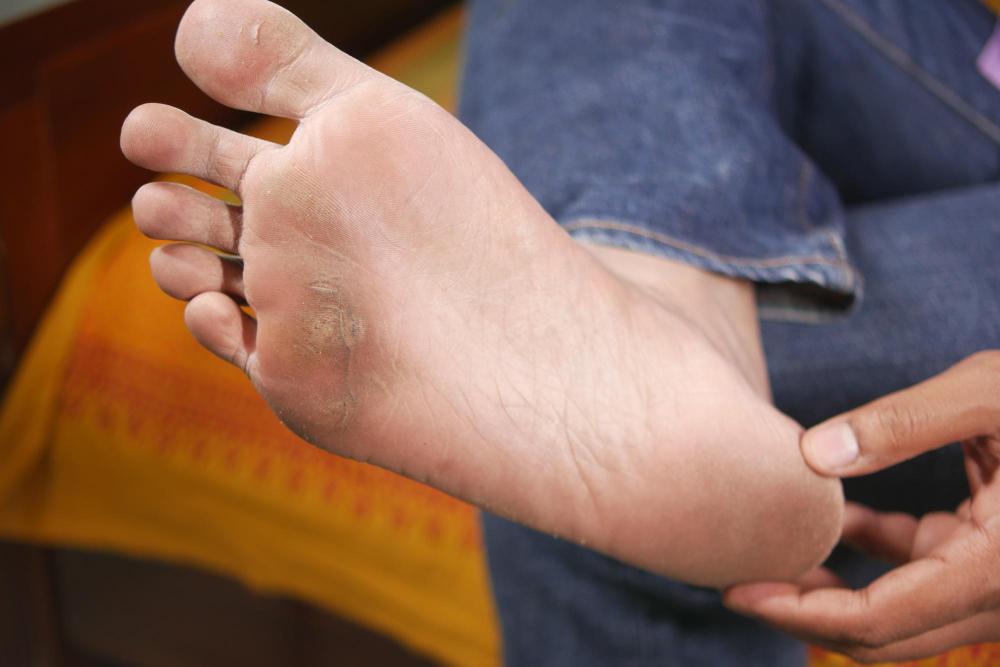 How To Tell If You Have Plantar Warts
